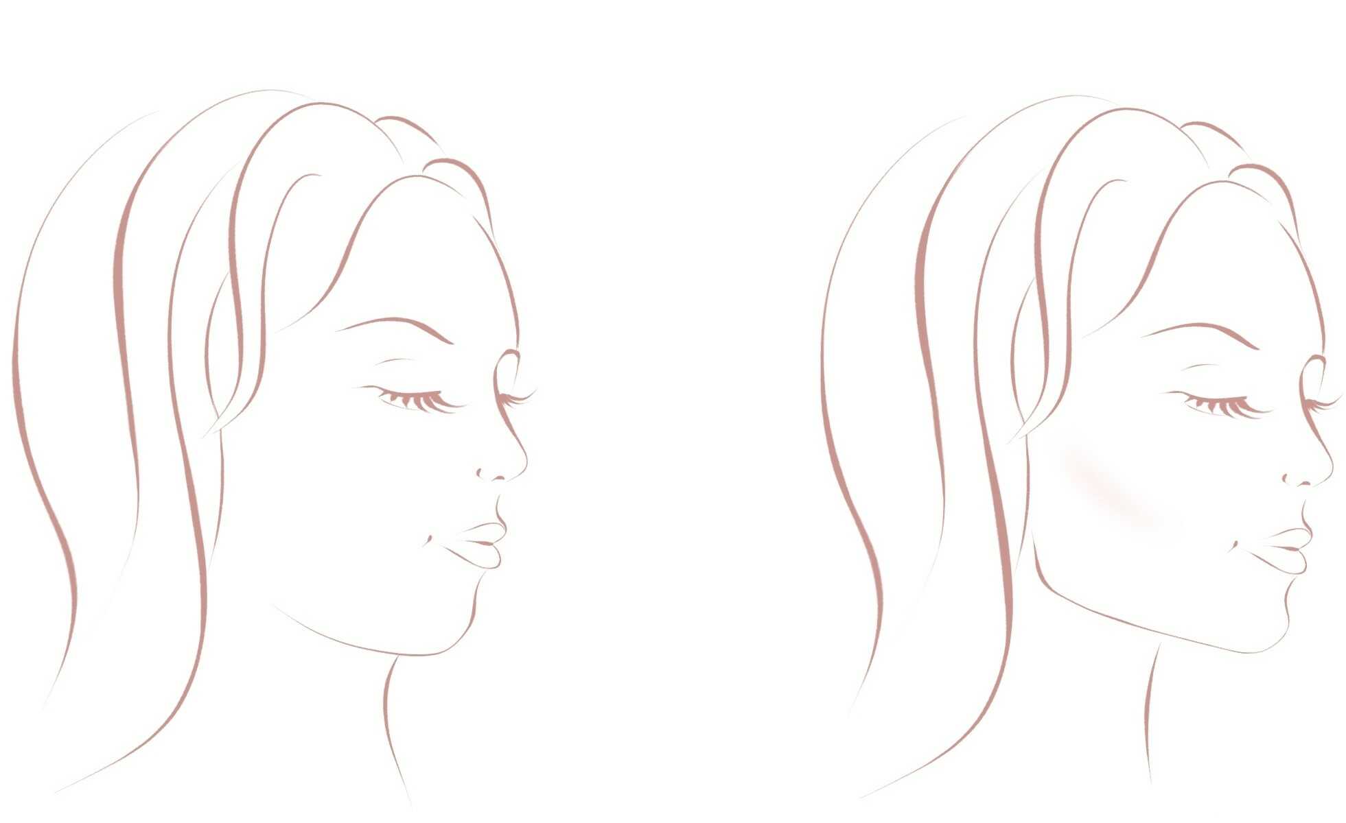 Vorher und Nachher einer Jawline Behandlung des Gesichts